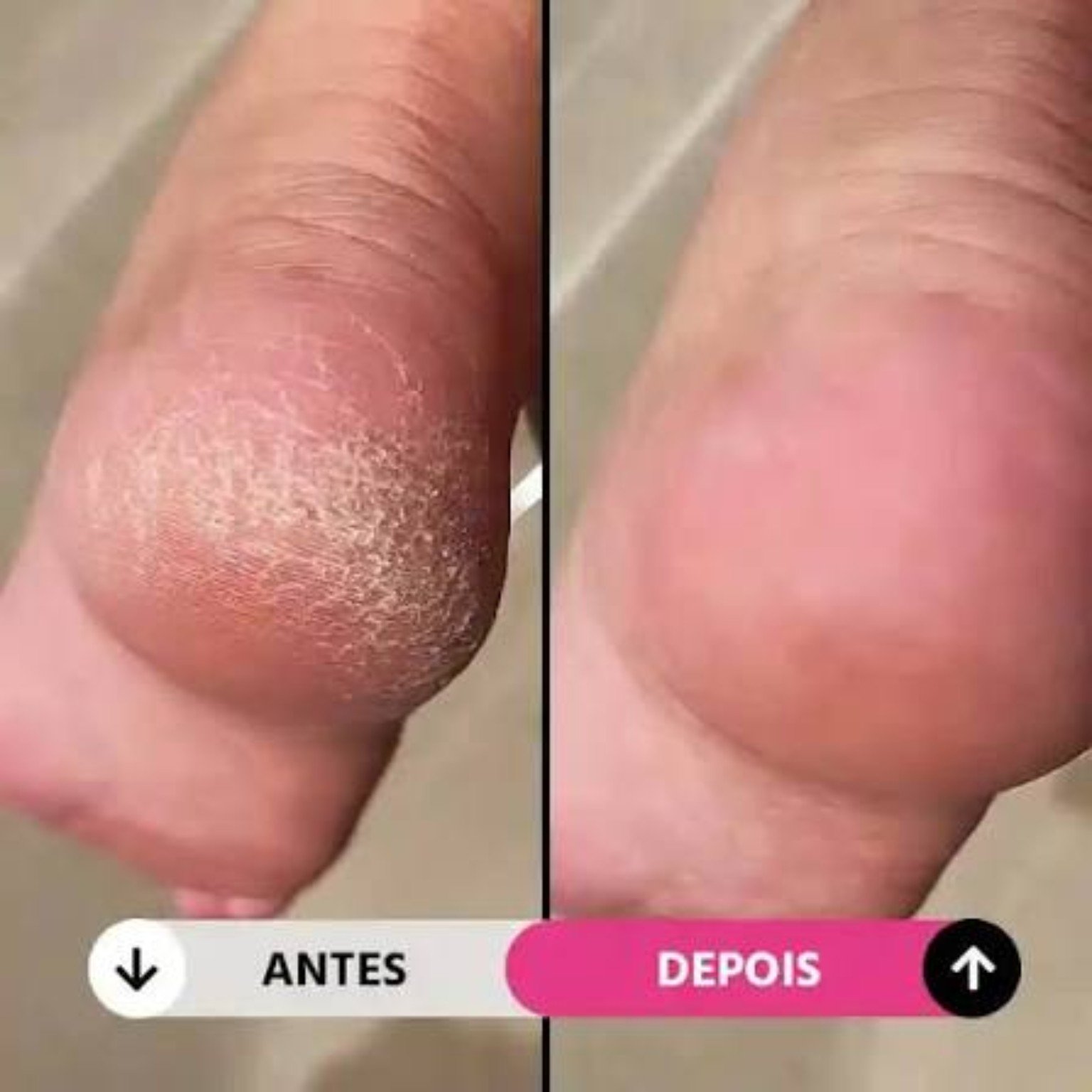 Antes e depois do cuidado com pés ressecados