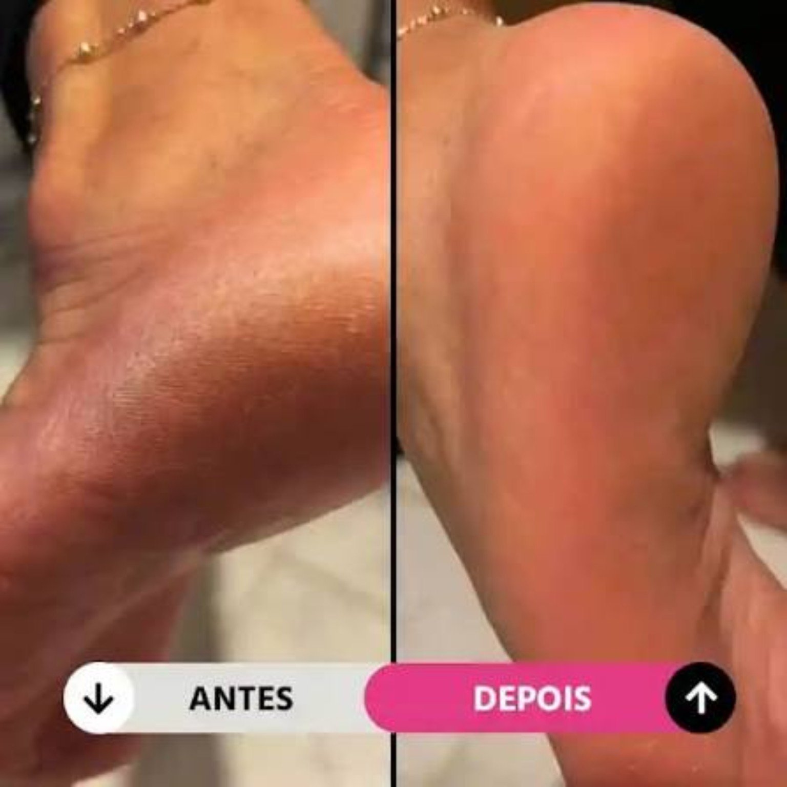 Antes e depois do calcanhar ressecado